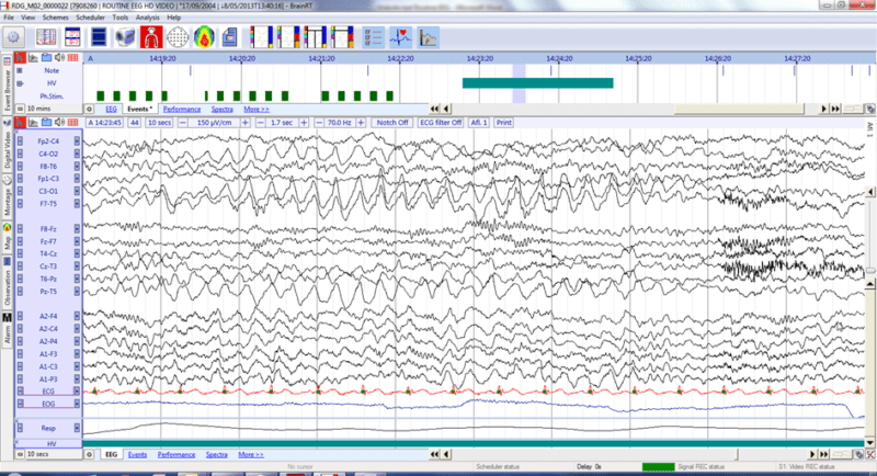 © Micromed © Micromed