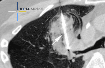 ©HEPTA Medical